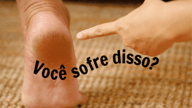 Rachaduras dos pés - Fonte Canva